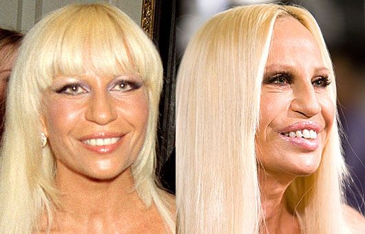 Donatella Versace Before and After Plastic Surgery - Vanity